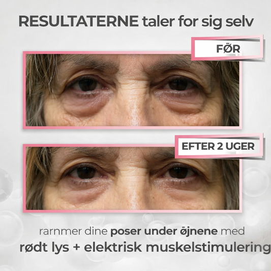 Øjenlys® – Fjern Øjenposer Med Lys & EMS